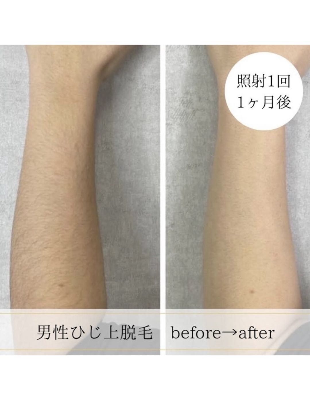 男性ひじ上脱毛のbefore after 照射1回1ヶ月後の写真