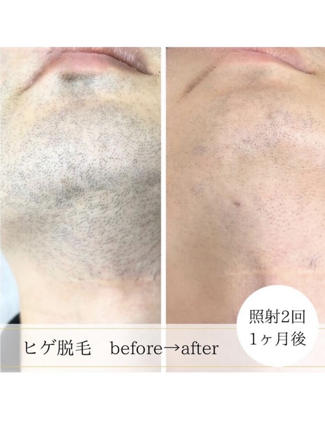 ヒゲ脱毛のbefore after 照射2回1ヶ月後の写真