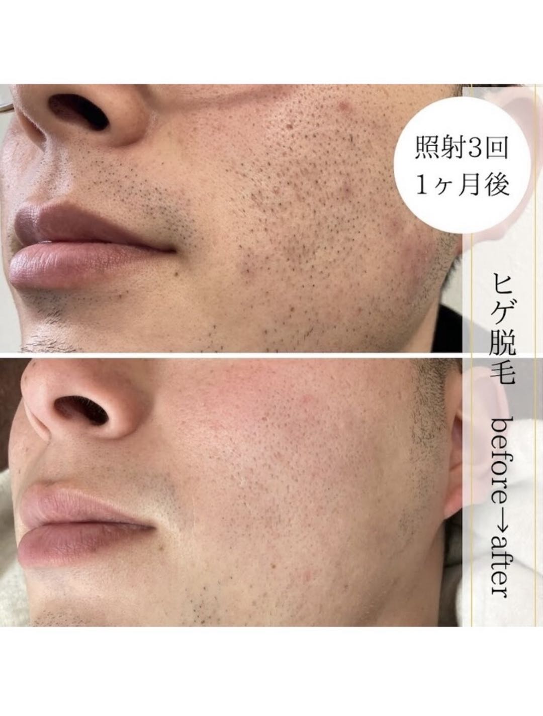 ヒゲ脱毛のbefore after 照射3回1ヶ月後の写真