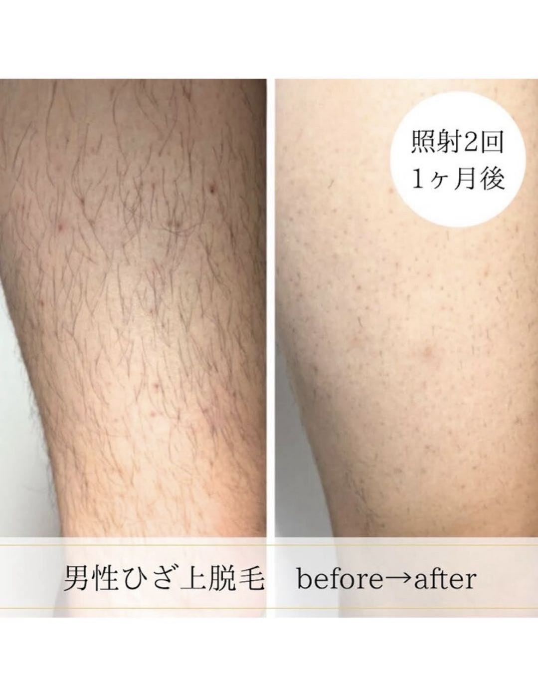 男性ひざ上脱毛のbefore after 照射2回1ヶ月後の写真