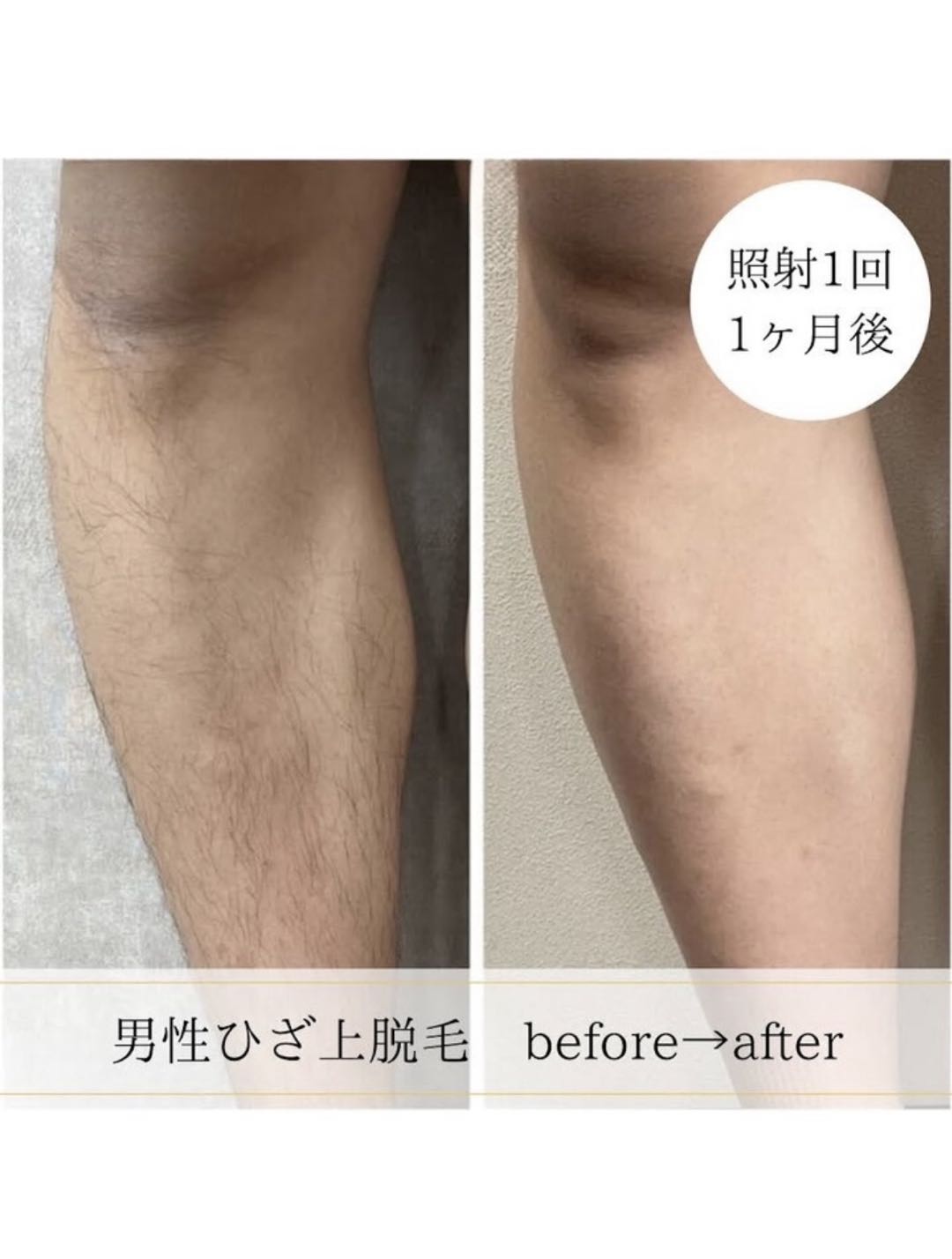 男性ひざ上脱毛のbefore after 照射1回1ヶ月後の写真